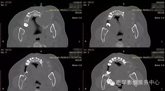 【病例】上颌窦癌1例CT影像表现 【病例】上颌窦癌1例CT影像表现