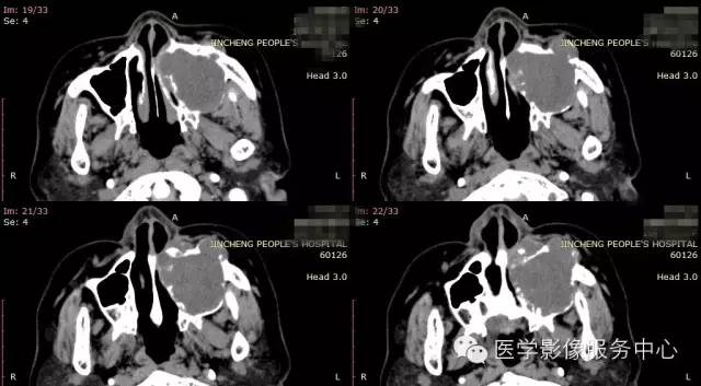【病例】上颌窦癌1例CT影像表现 【病例】上颌窦癌1例CT影像表现