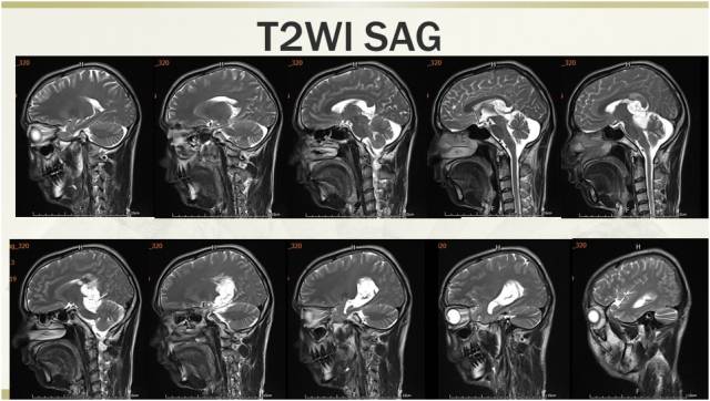 【病例】少突胶质细胞瘤伴广泛粘液变性1例MR影像表现 【病例】少突胶质细胞瘤伴广泛粘液变性1例MR影像表现