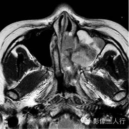 鼻腔黑色素瘤的诊断要点及鉴别诊断 鼻腔黑色素瘤的诊断要点及鉴别诊断
