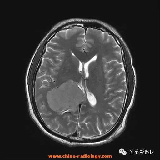 【病例】侧脑室脑膜瘤 【病例】侧脑室脑膜瘤