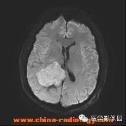 【病例】侧脑室脑膜瘤 【病例】侧脑室脑膜瘤
