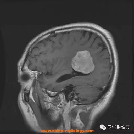 【病例】侧脑室脑膜瘤 【病例】侧脑室脑膜瘤