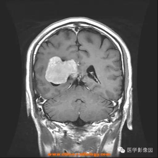 【病例】侧脑室脑膜瘤 【病例】侧脑室脑膜瘤