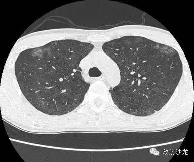 【病例】肺孢子菌肺炎影像表现1例 【病例】肺孢子菌肺炎影像表现1例
