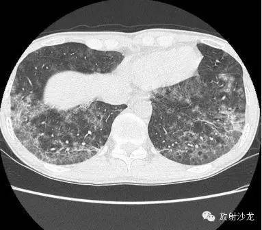 【病例】肺孢子菌肺炎影像表现1例 【病例】肺孢子菌肺炎影像表现1例