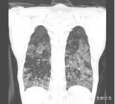 【病例】肺孢子菌肺炎影像表现1例 【病例】肺孢子菌肺炎影像表现1例