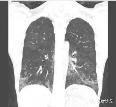 【病例】肺孢子菌肺炎影像表现1例 【病例】肺孢子菌肺炎影像表现1例