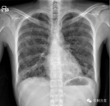 【病例】肺孢子菌肺炎影像表现1例 【病例】肺孢子菌肺炎影像表现1例
