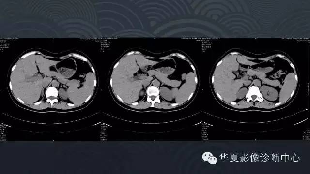 【病例】胰尾副脾1例CT及MR影像表现