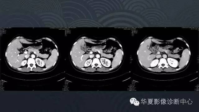 【病例】胰尾副脾1例CT及MR影像表现