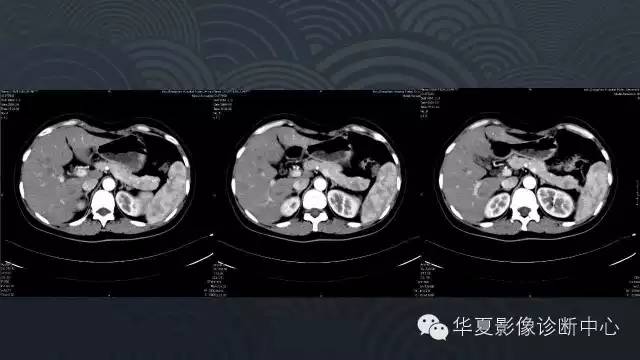 【病例】胰尾副脾1例CT及MR影像表现