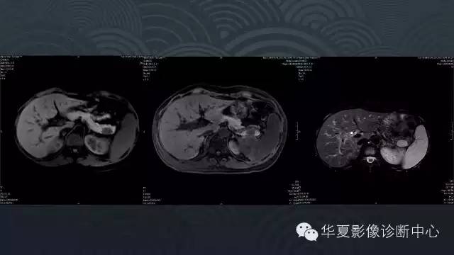 【病例】胰尾副脾1例CT及MR影像表现