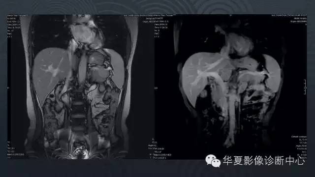 【病例】胰尾副脾1例CT及MR影像表现