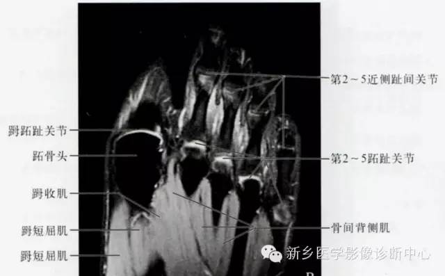 足部断层解剖+详细标注