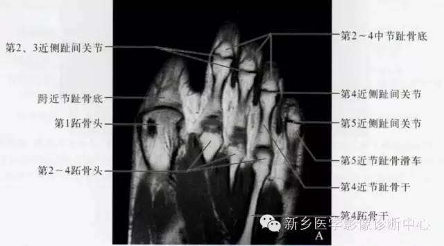 足部断层解剖+详细标注
