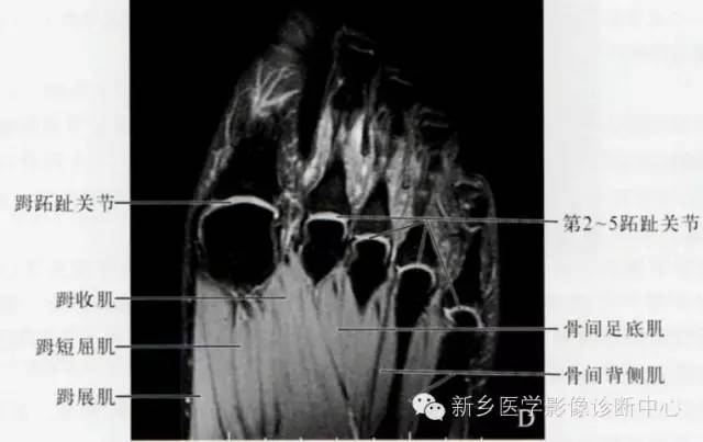 足部断层解剖+详细标注