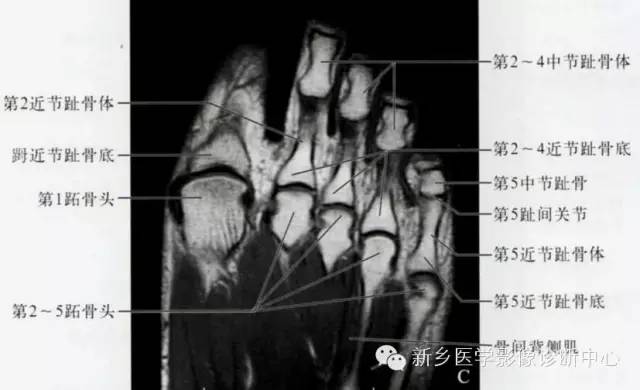 足部断层解剖+详细标注
