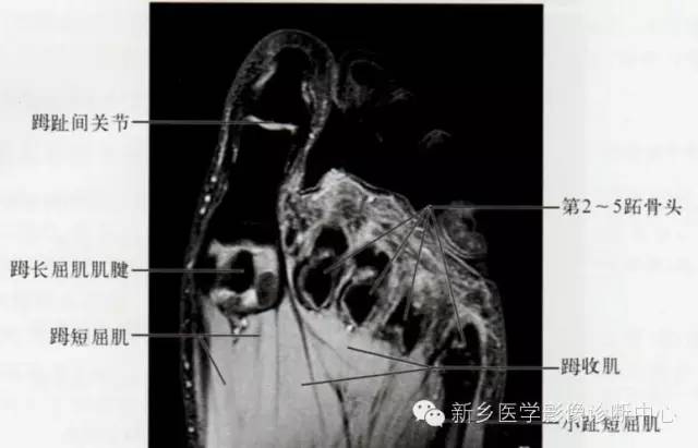 足部断层解剖+详细标注
