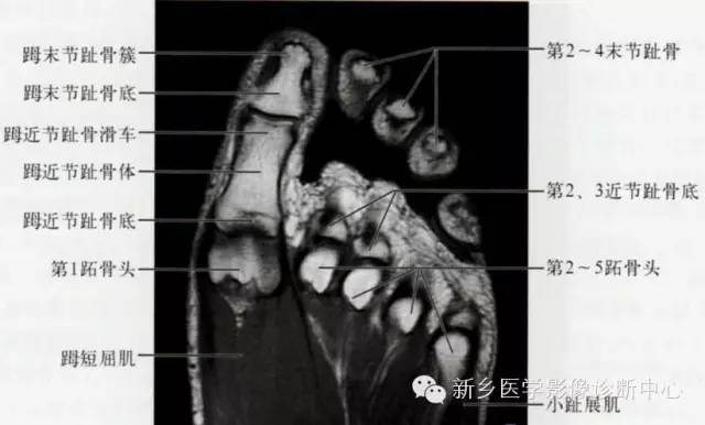 足部断层解剖+详细标注