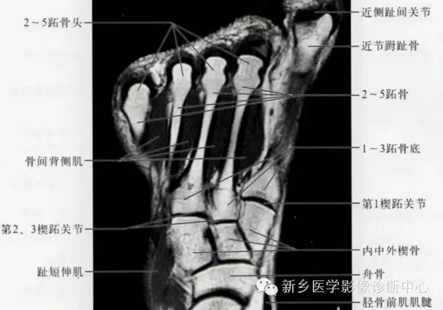 足部断层解剖+详细标注