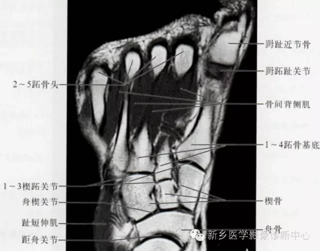 足部断层解剖+详细标注