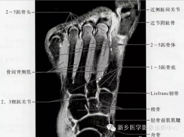 足部断层解剖+详细标注