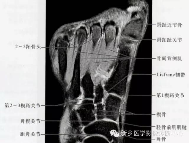 足部断层解剖+详细标注