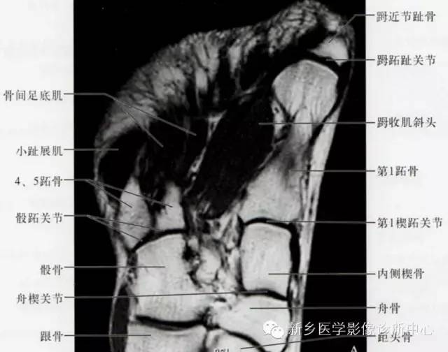足部断层解剖+详细标注