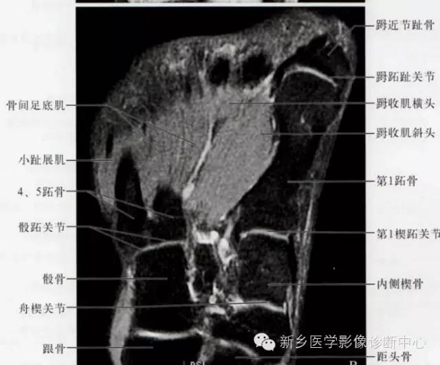 足部断层解剖+详细标注