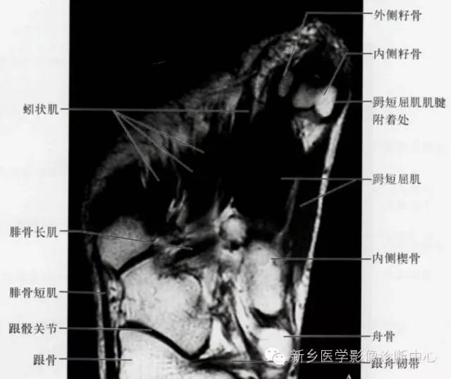 足部断层解剖+详细标注
