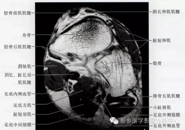 足部断层解剖+详细标注