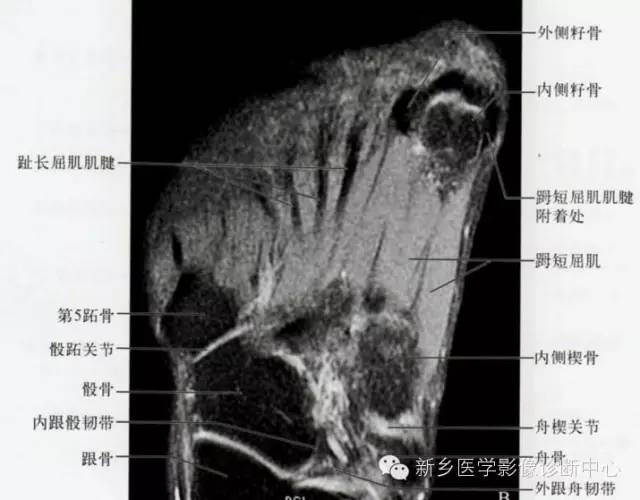 足部断层解剖+详细标注