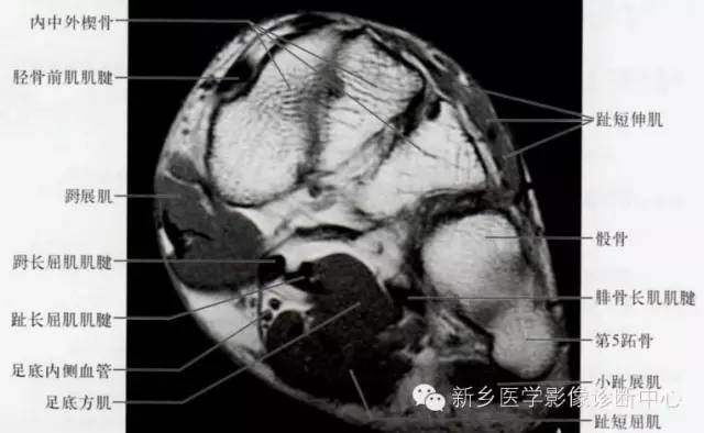 足部断层解剖+详细标注