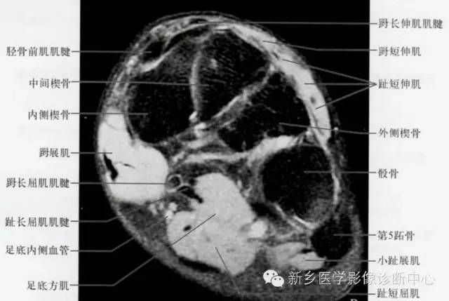 足部断层解剖+详细标注