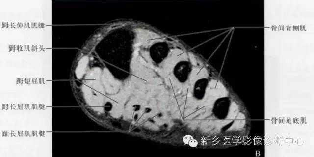 足部断层解剖+详细标注