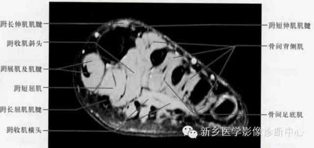 足部断层解剖+详细标注