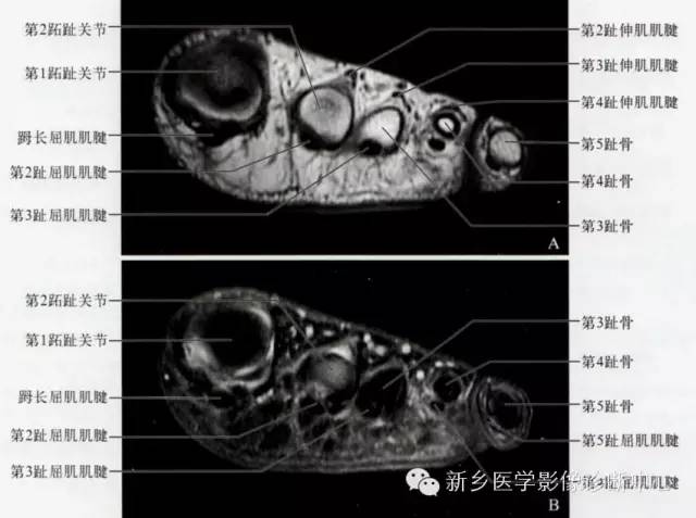 足部断层解剖+详细标注
