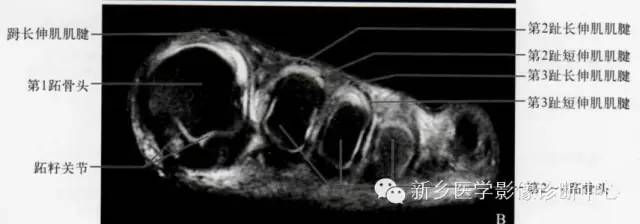 足部断层解剖+详细标注