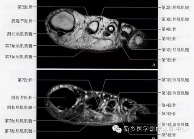 足部断层解剖+详细标注