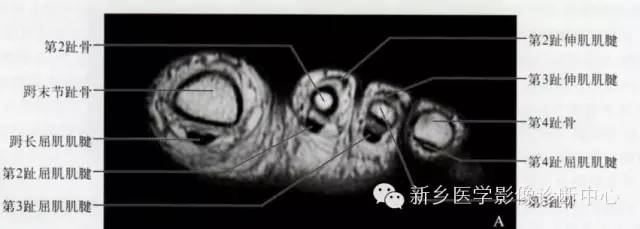 足部断层解剖+详细标注