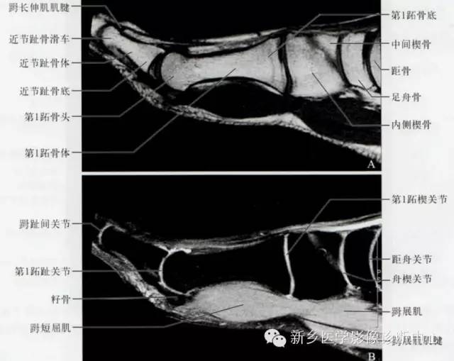 足部断层解剖+详细标注