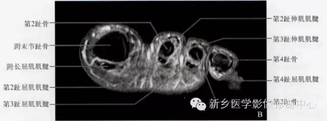 足部断层解剖+详细标注