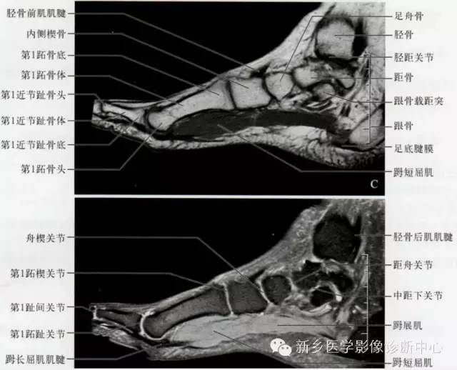 足部断层解剖+详细标注