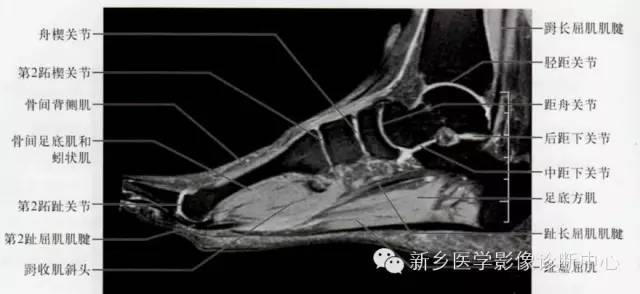 足部断层解剖+详细标注