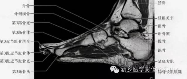 足部断层解剖+详细标注