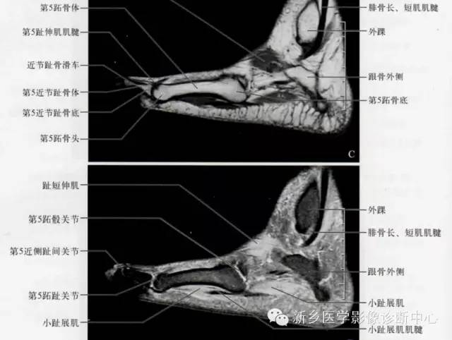 足部断层解剖+详细标注