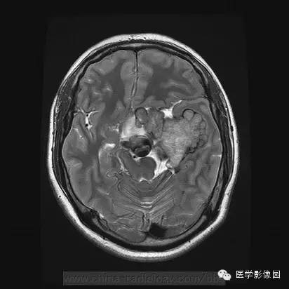 【病例】侵袭性垂体瘤1例MR影像表现