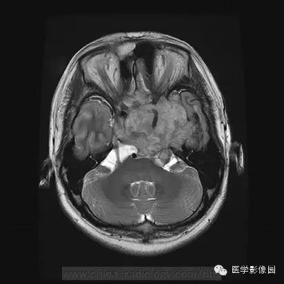 【病例】侵袭性垂体瘤1例MR影像表现