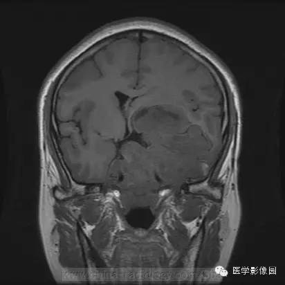 【病例】侵袭性垂体瘤1例MR影像表现